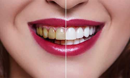 Dental cleaning fillings and gum care
